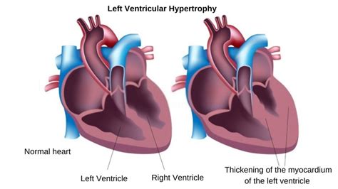 left ventricular wall thickness measurement|left ventricular hypertrophy symptoms.